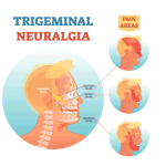 Trigeminal Neuralgia in pune